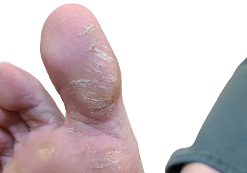 Callus_After