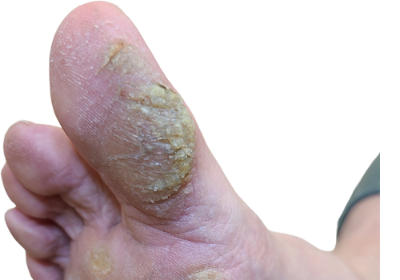 Callus_Before