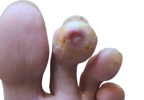 Diabetic_After