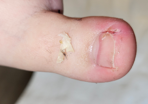 Ingrown_Afterbackground