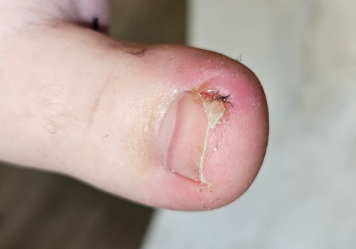 Ingrown_Beforebackground