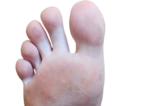Warts_After