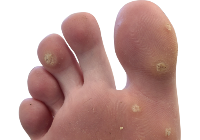 Warts_Before-1